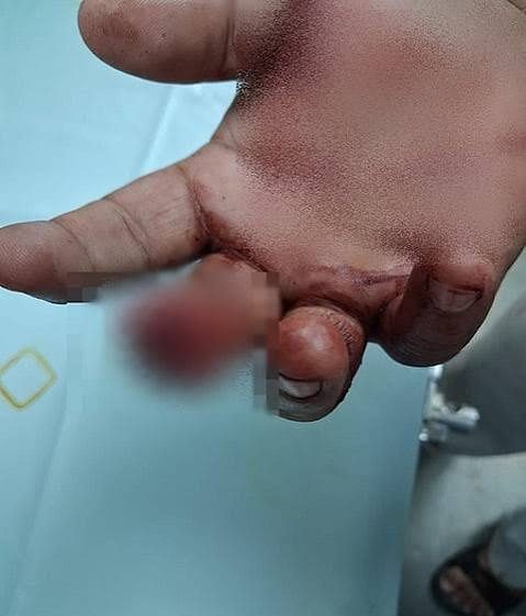 Telangana: Man bites cop’s finger, arrested